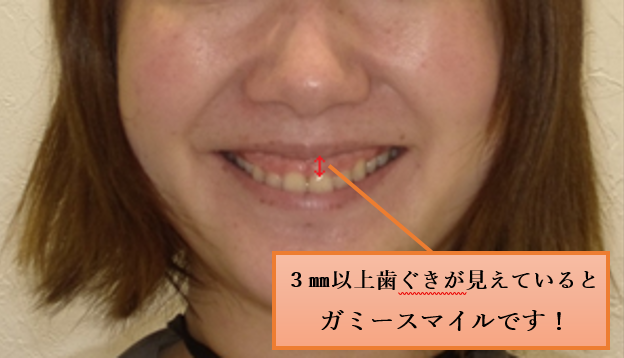 高蔵寺 笑った時に歯茎が見える ガミースマイル治療 公式 名古屋市守山区で歯医者ならしだみ歯科へ